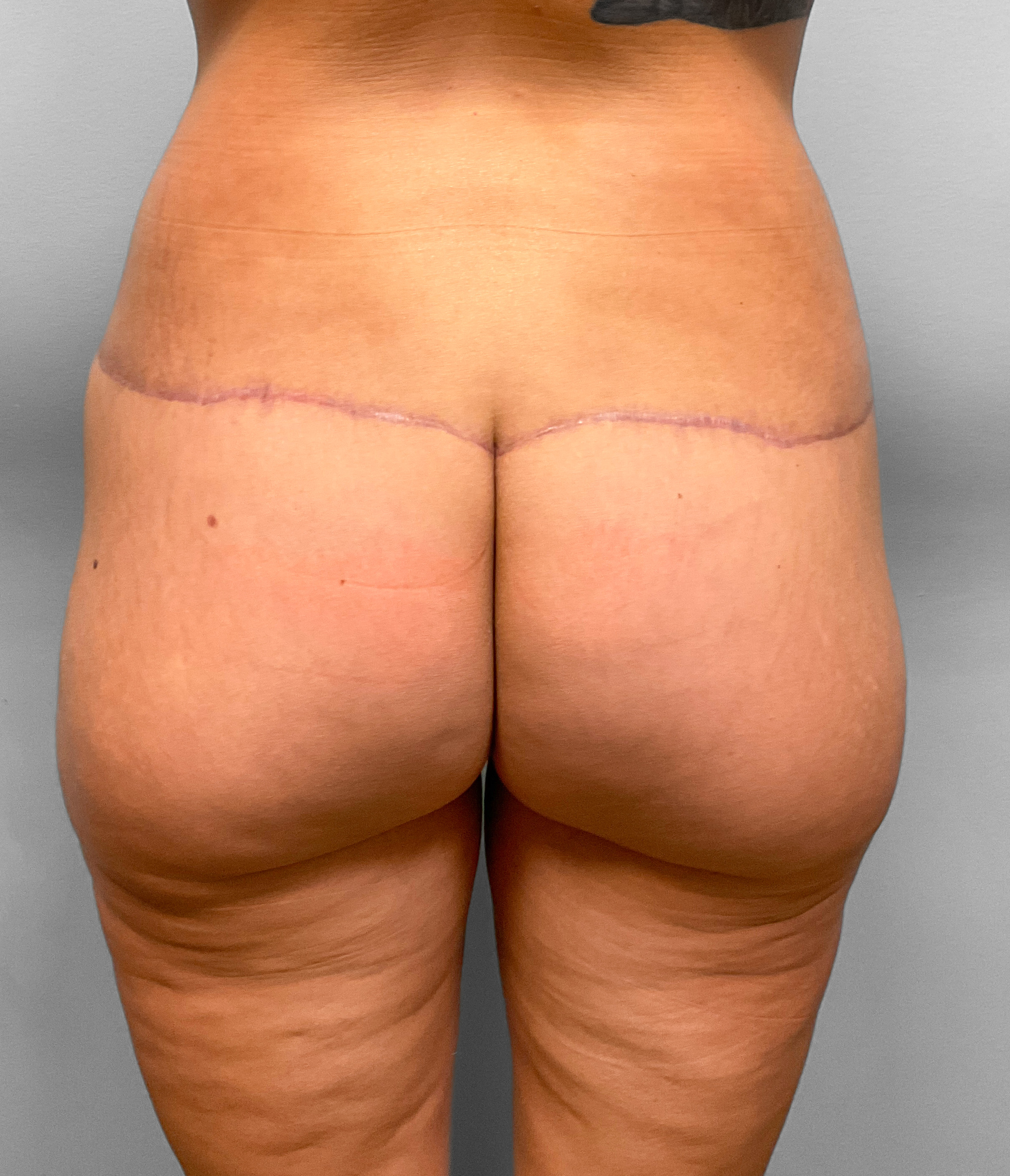 After Image: Butt Lift- Dr. Howell - front