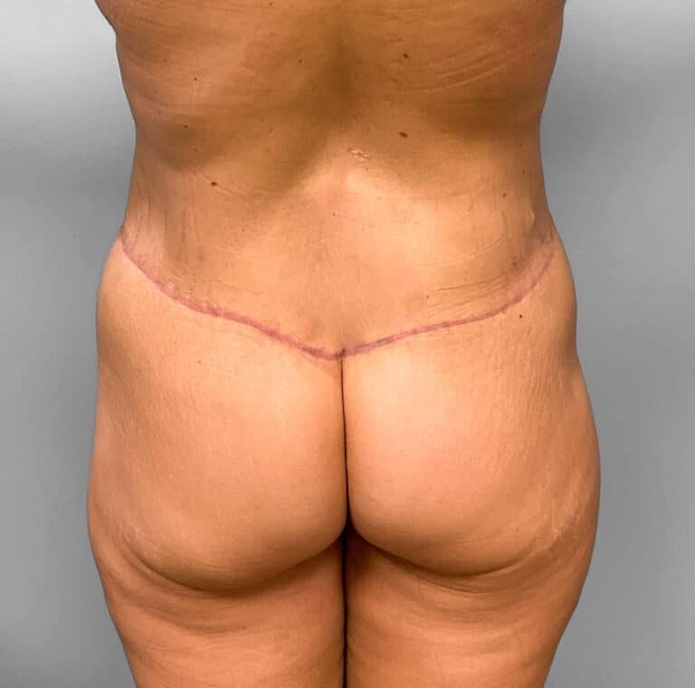After Image: Body Lift – Dr. Howell - back