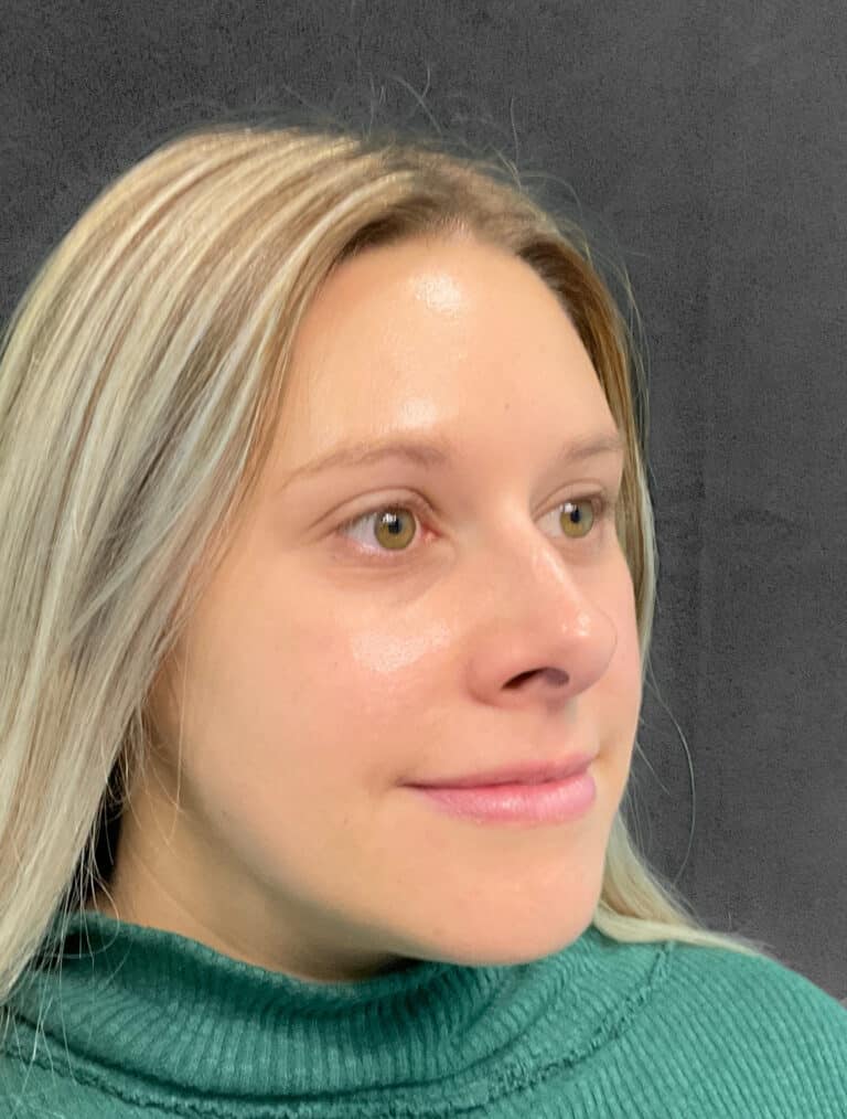 After Image: Botox- Joy - right-front-oblique