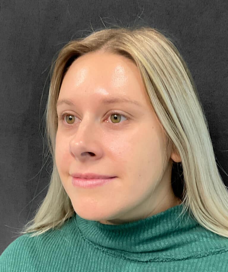 After Image: Botox- Joy -