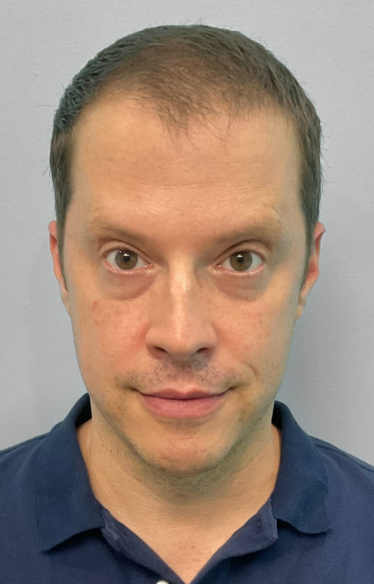 After Image: Botox- Joy -