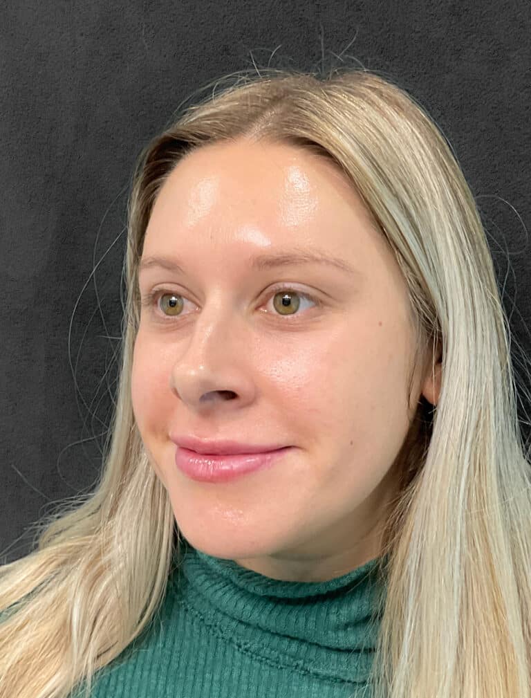 After Image: Juvéderm Ultra- Joy - left-front-oblique