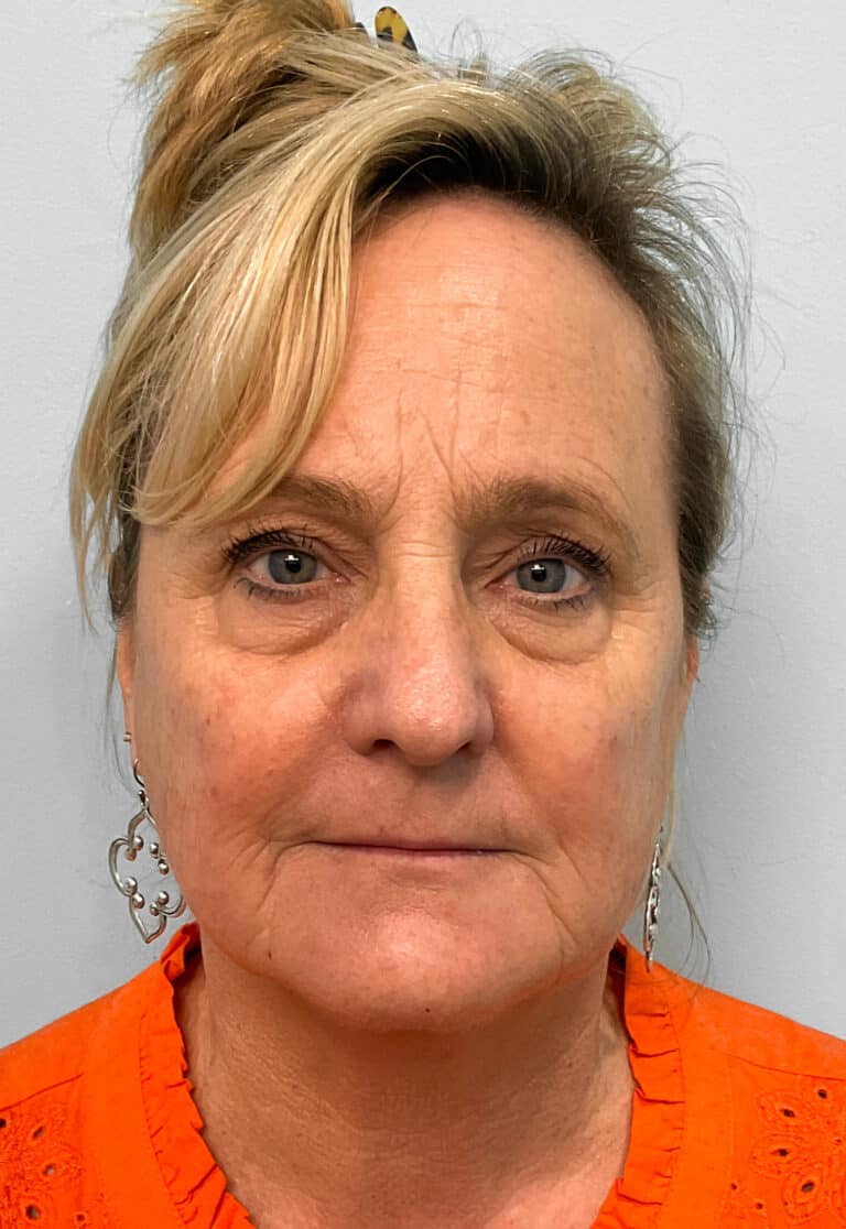 After Image: Juvéderm Voluma- Joy - front