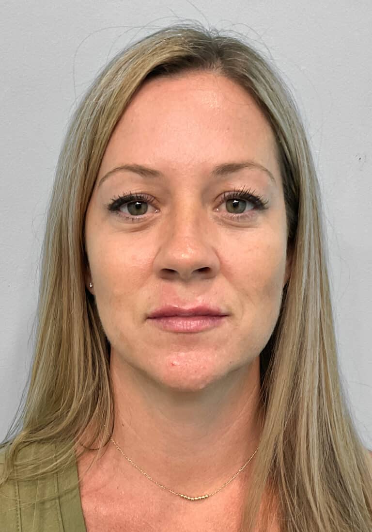 After Image: Juvéderm Volbella & Botox- Joy - front
