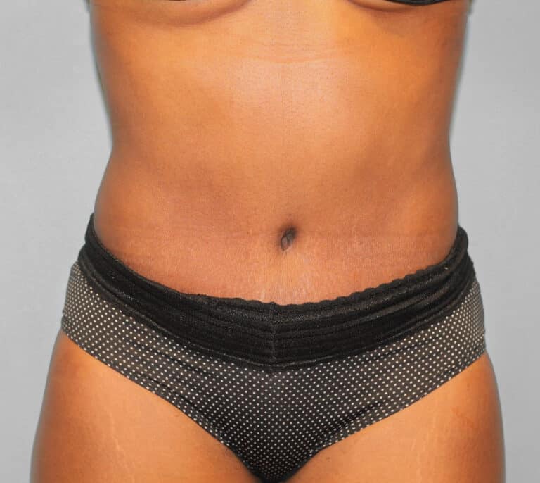 After Image: Abdominoplasty (Tummy Tuck) – Dr. Howell - front