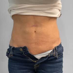 After Image: Coolsculpting- Jessica