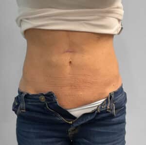 Coolsculpting- Jessica