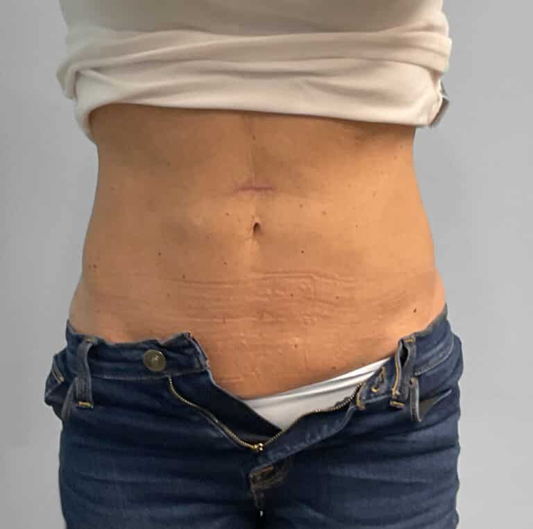 After Image: Coolsculpting- Jessica - front