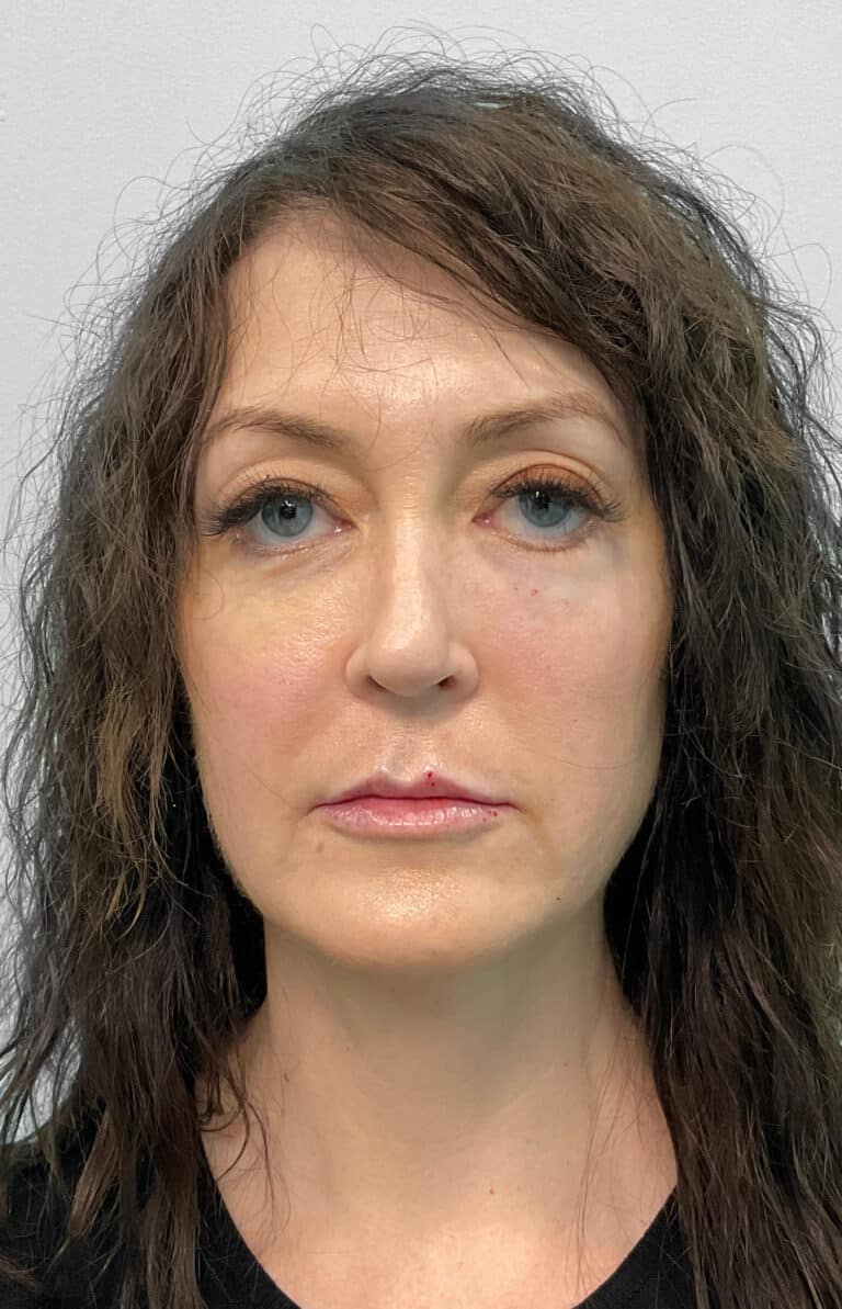 After Image: Juvéderm Ultra, Voluma, & Botox- Joy - front