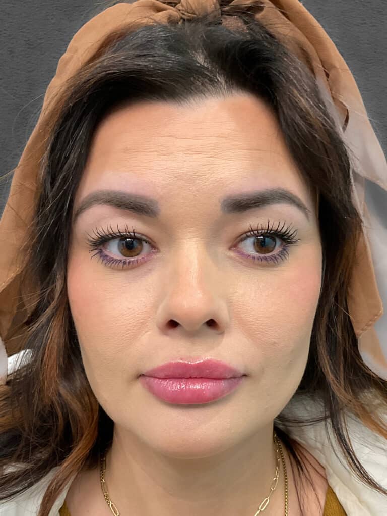 After Image: Juvéderm Ultra & Voluma- Heather - front