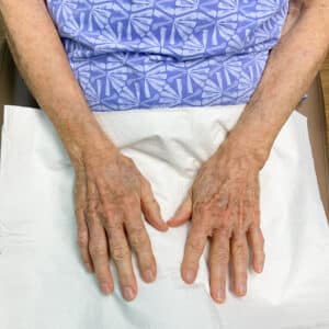 After Image: Laser Treatment- Jade