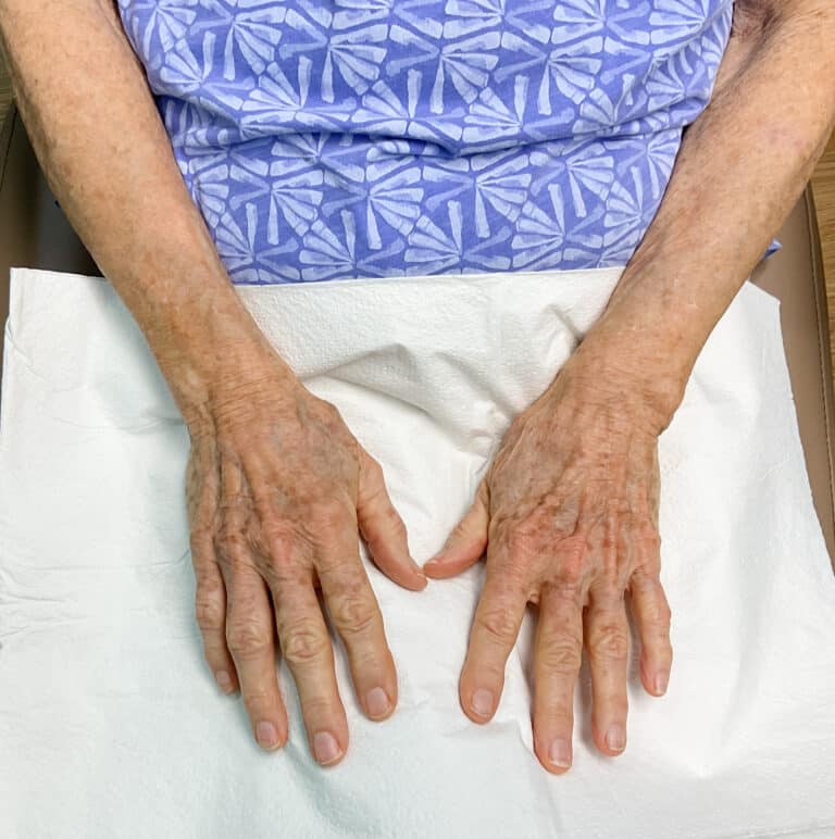 After Image: Laser Treatment- Jade - front