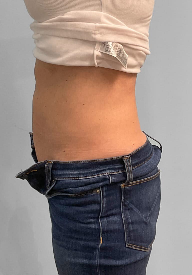 After Image: Coolsculpting- Jessica - left-side