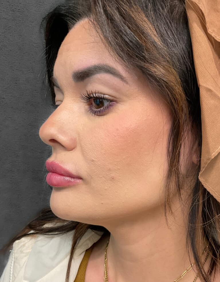 After Image: Juvéderm Ultra & Voluma- Heather - left-front-oblique