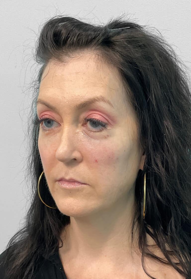 After Image: Juvéderm Ultra, Voluma, & Botox- Joy - left-front-oblique