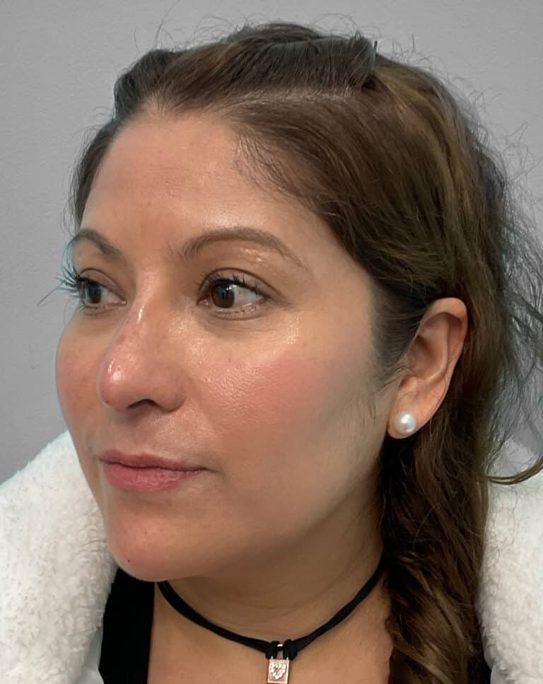 After Image: Juvéderm Voluma- Joy - left-front-oblique