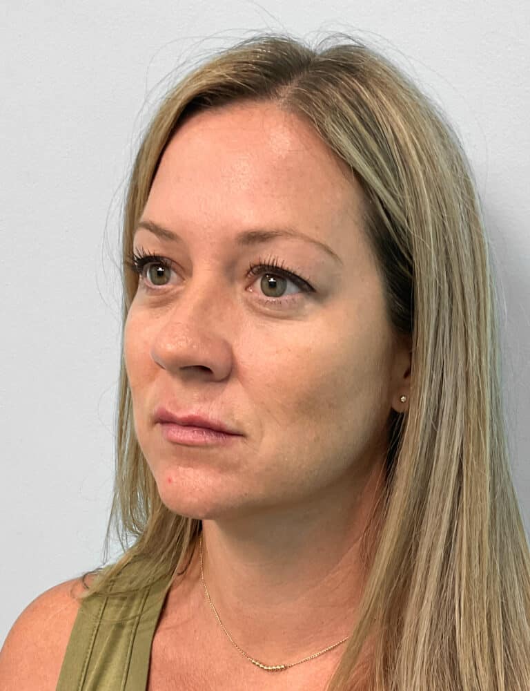 After Image: Juvéderm Volbella & Botox- Joy - left-front-oblique