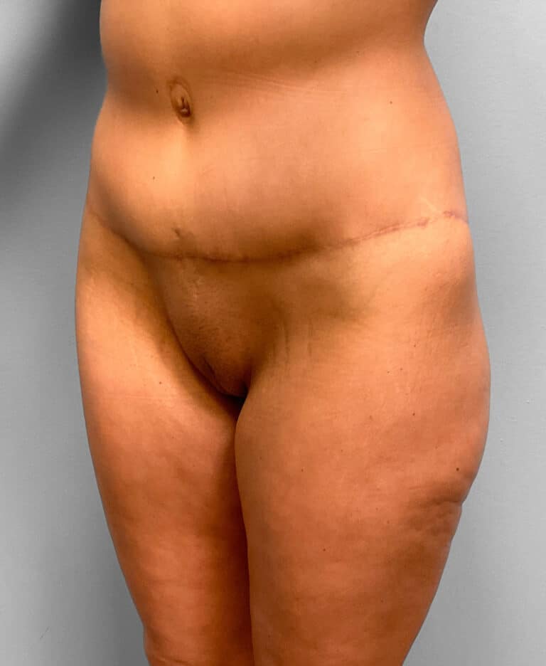 After Image: Butt Lift- Dr. Howell - left-front-oblique