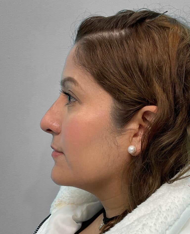 After Image: Juvéderm Voluma- Joy - left-side