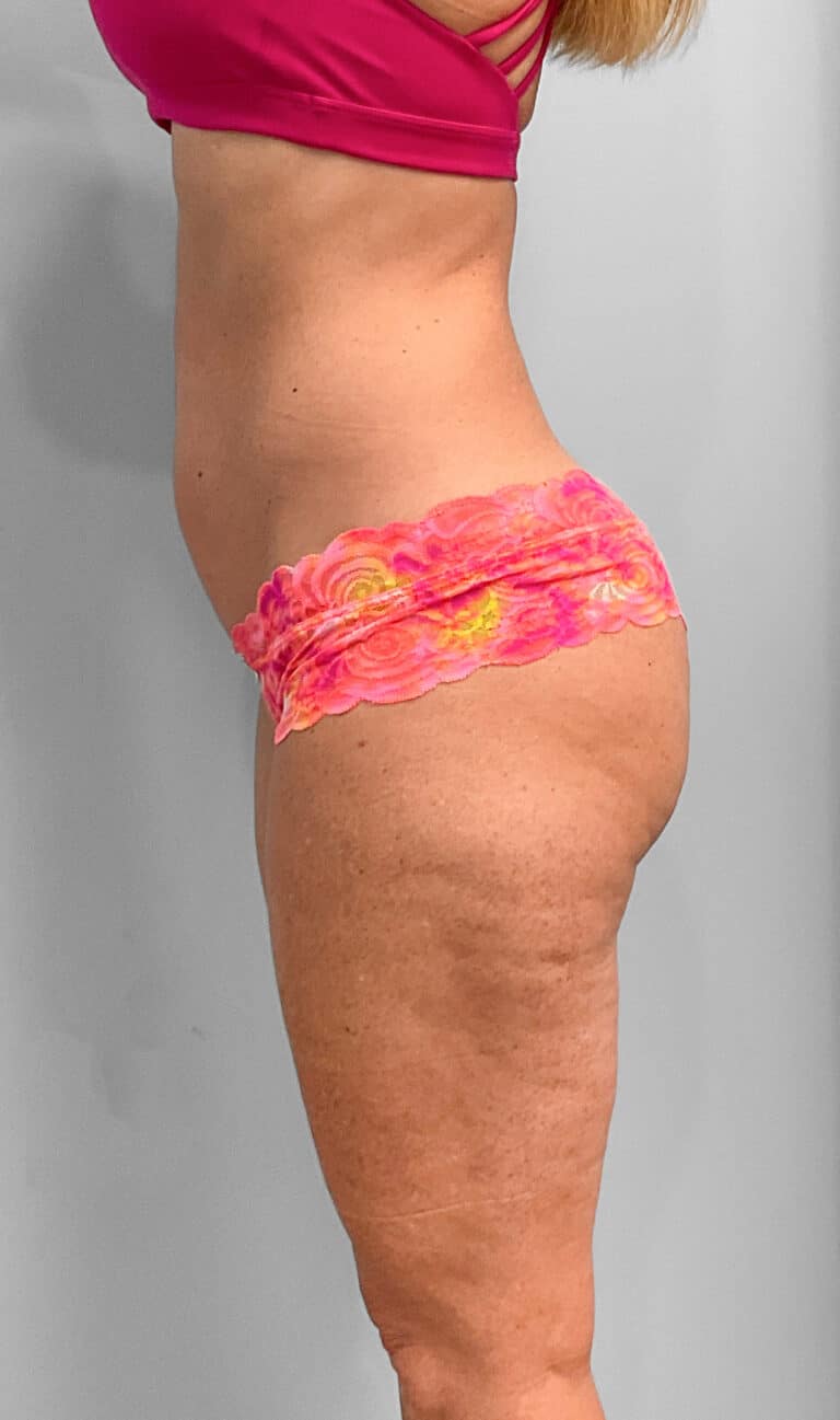 After Image: Emsculpt Neo- Jessica - left-side