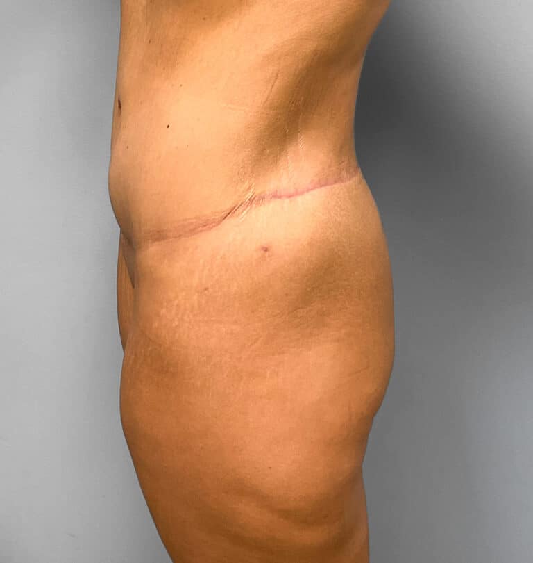 After Image: Body Lift – Dr. Howell - left-side