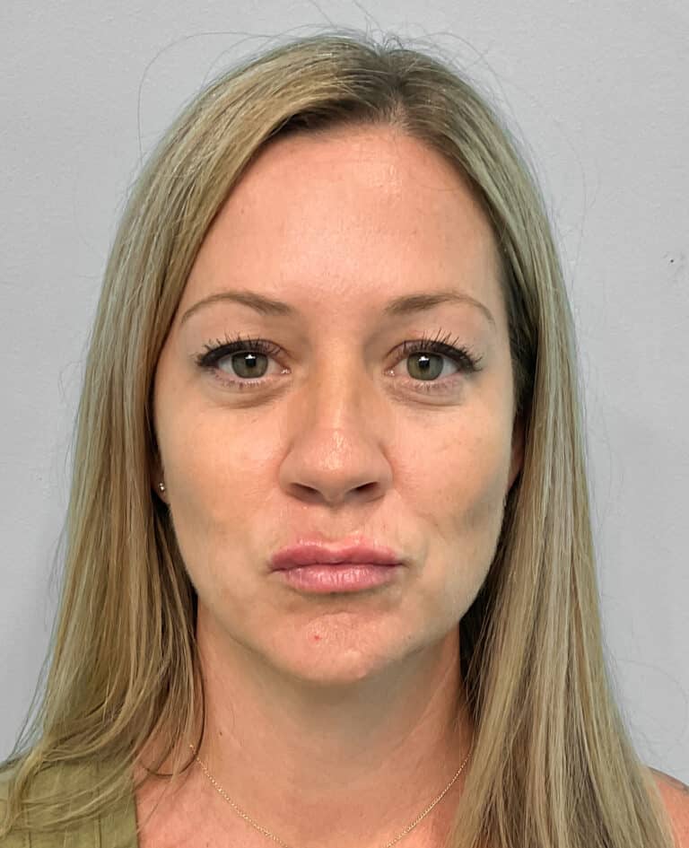 After Image: Juvéderm Volbella & Botox- Joy - front