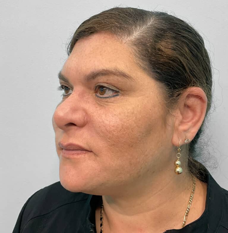 After Image: Kybella- Joy - left-front-oblique