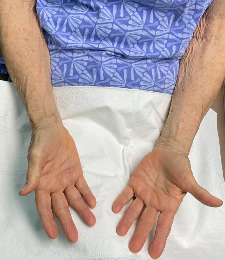 After Image: Laser Treatment- Jade - back