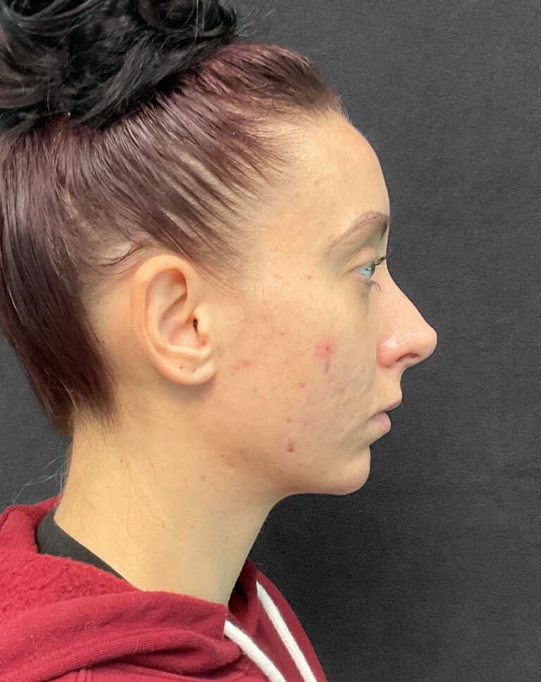 After Image: Juvéderm Voluma- Joy - right-side