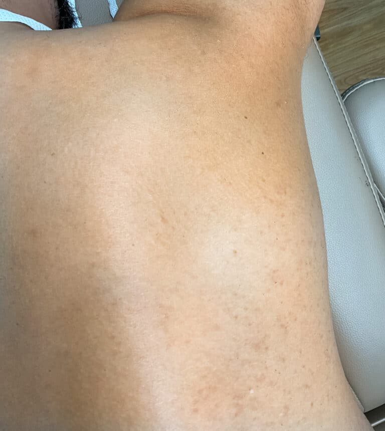 After Image: Laser Hair Removal- Jade - right-side