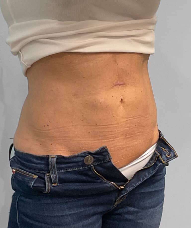 After Image: Coolsculpting- Jessica - right-front-oblique