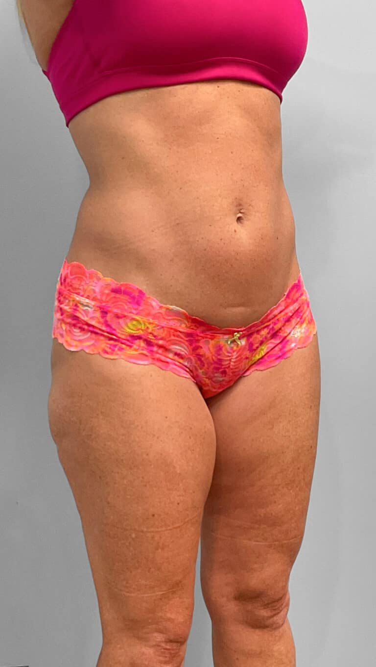 After Image: Emsculpt Neo- Jessica - right-front-oblique