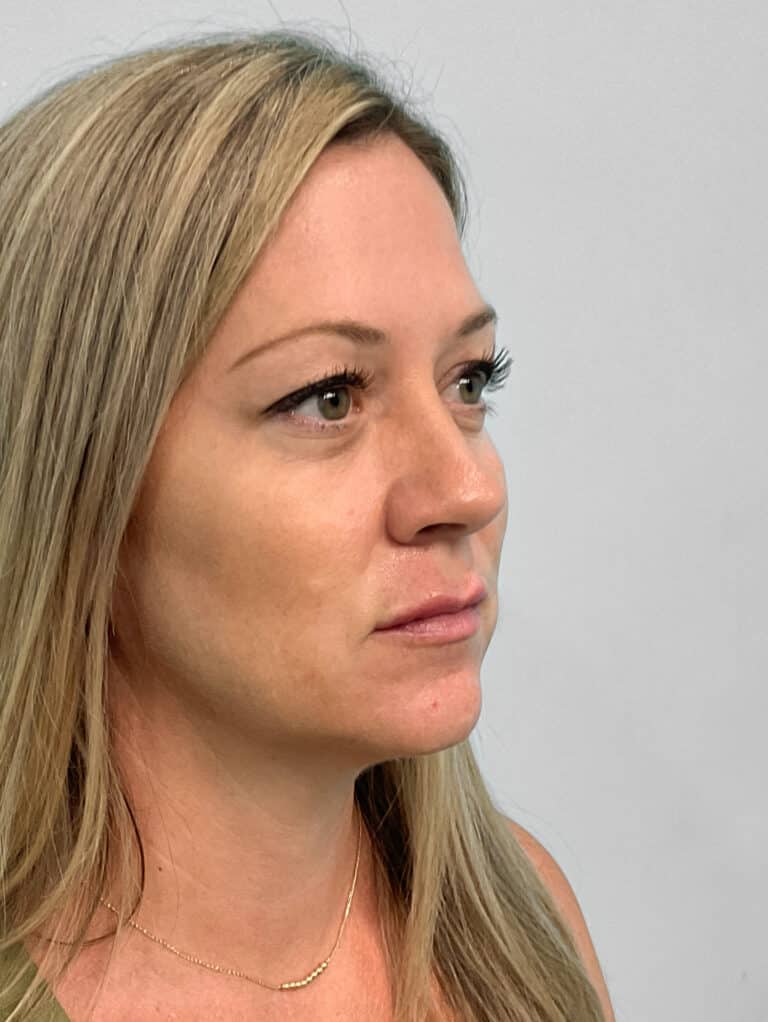 After Image: Juvéderm Volbella & Botox- Joy - right-front-oblique
