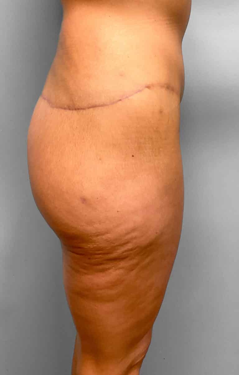 After Image: Butt Lift- Dr. Howell - right-side