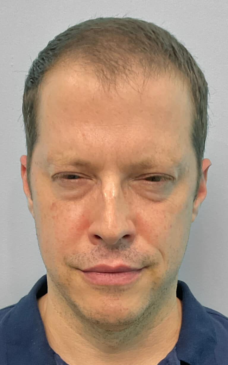 After Image: Botox- Joy -