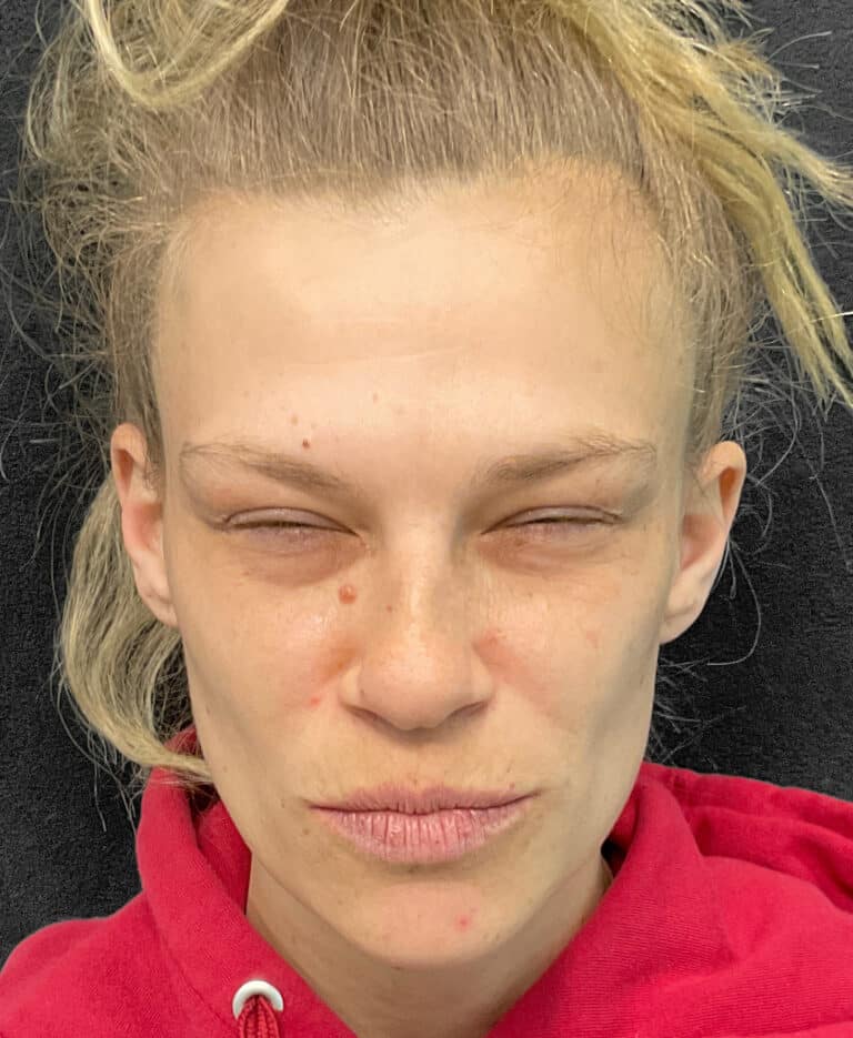 After Image: Botox- Joy - front