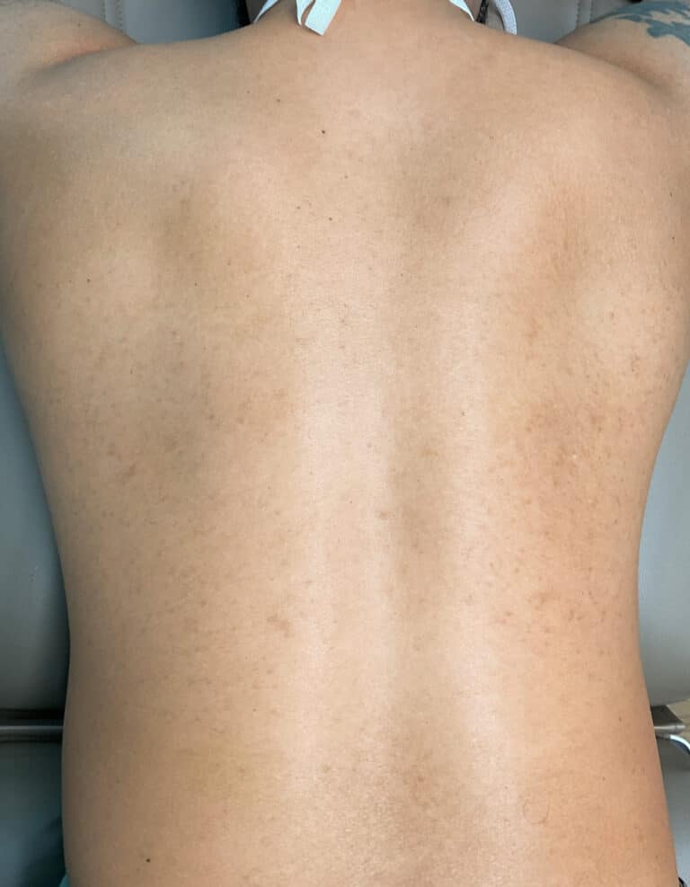 After Image: Laser Hair Removal- Jade - back