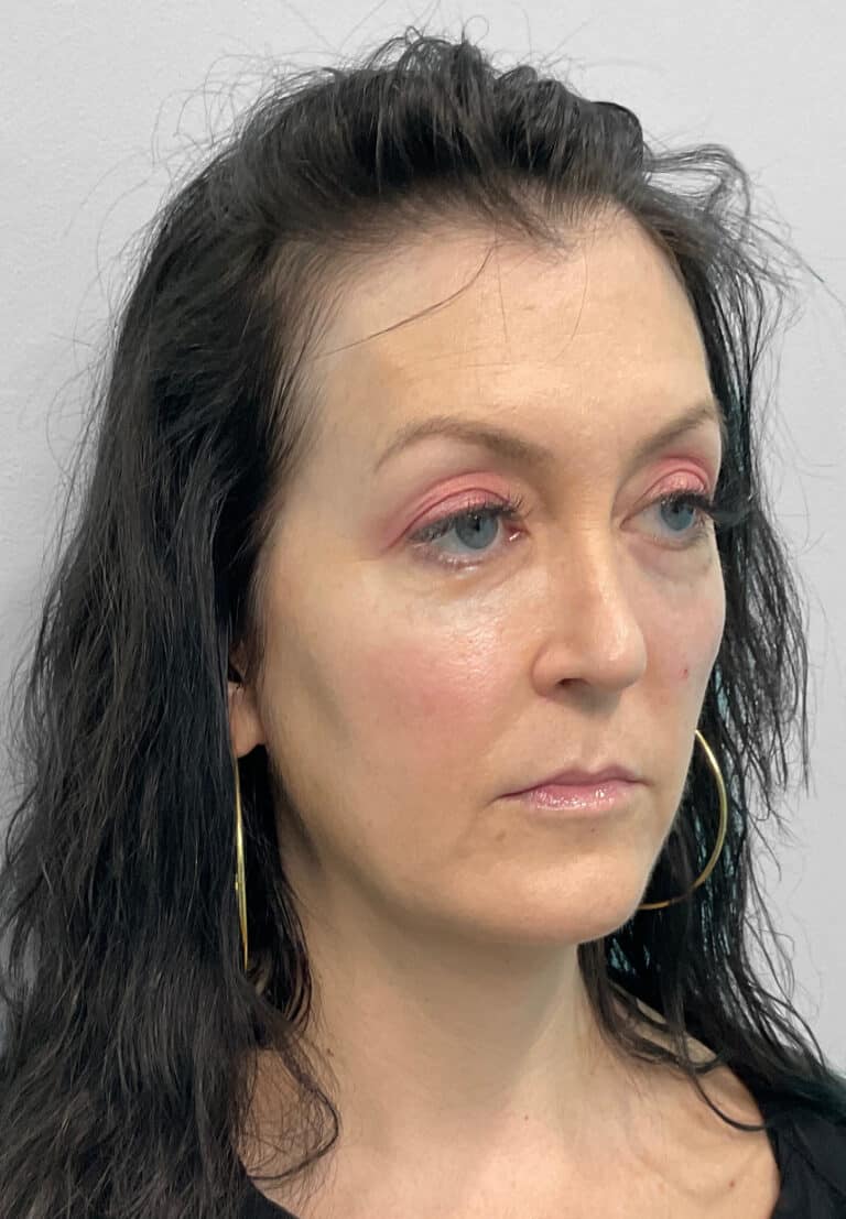 After Image: Juvéderm Ultra, Voluma, & Botox- Joy - right-front-oblique