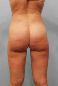 SmartLipo- Dr. Howell
