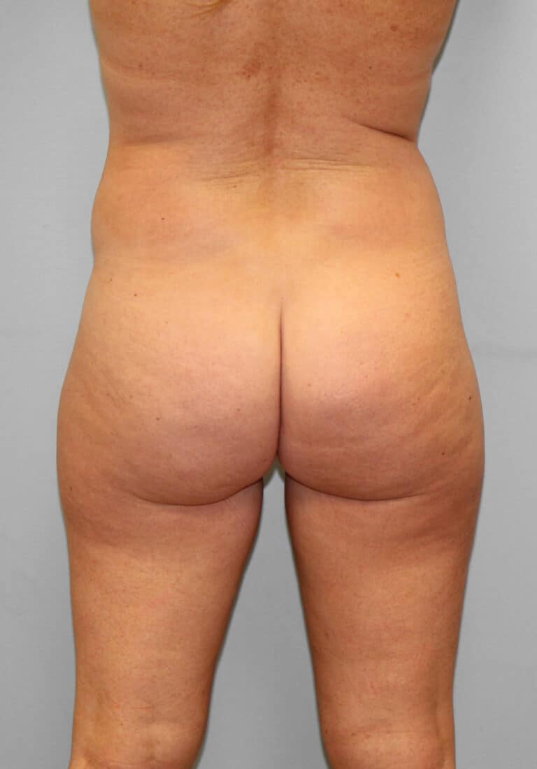 Before Image: SmartLipo- Dr. Howell - back