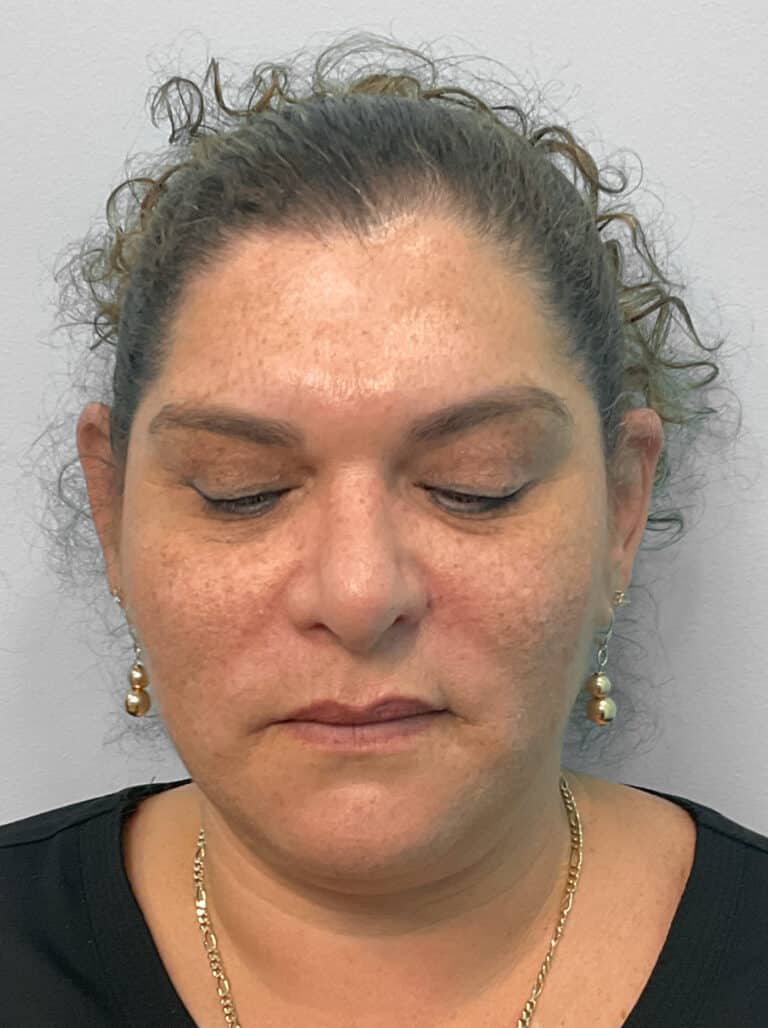 Before Image: Kybella- Joy - front