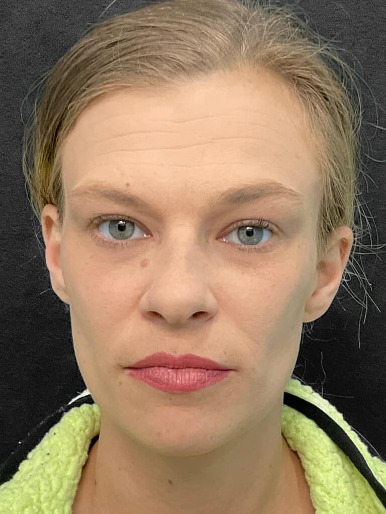 Before Image: Botox- Joy - front