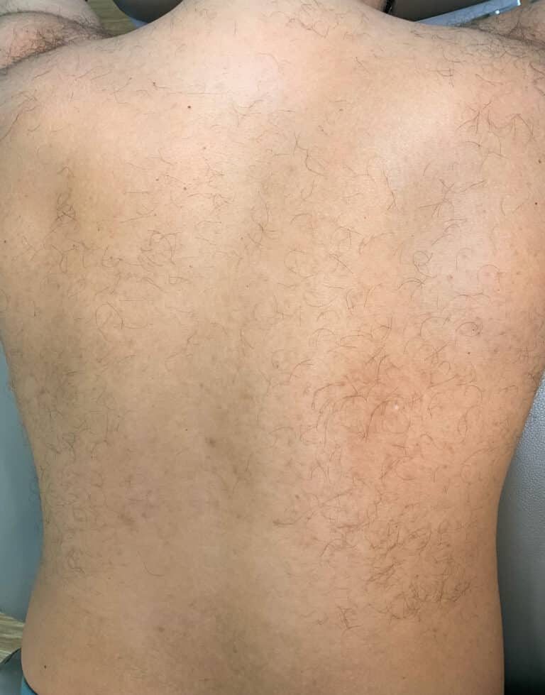 Before Image: Laser Hair Removal- Jade - back