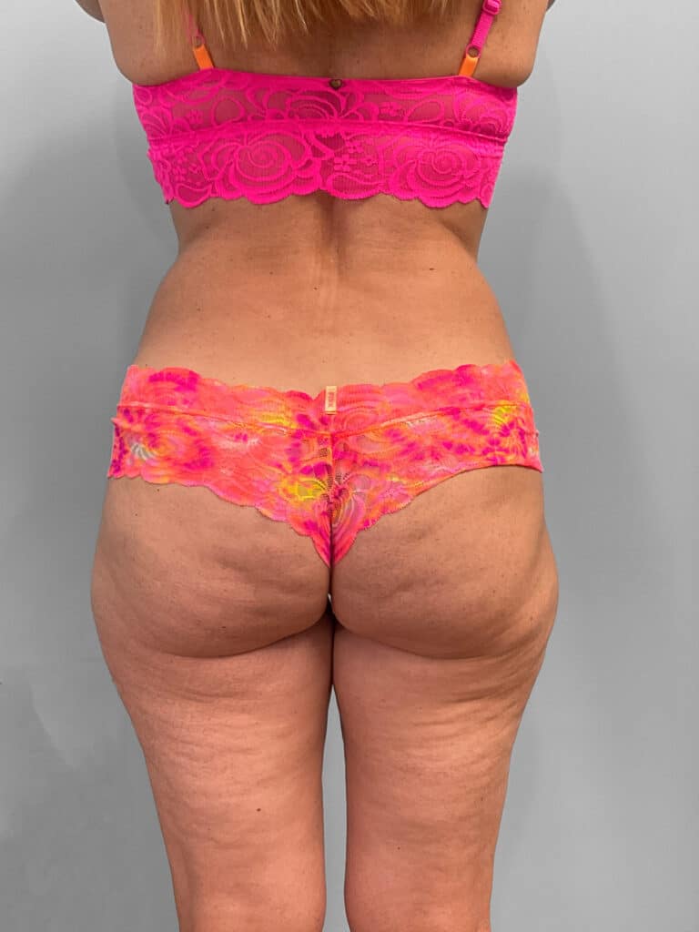 Before Image: Emsculpt Neo- Jessica - back