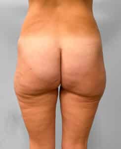 Before Image: Butt Lift- Dr. Howell