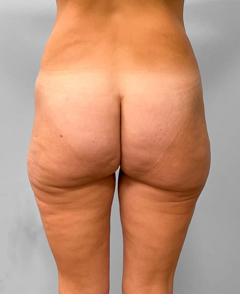 Before Image: Butt Lift- Dr. Howell - front