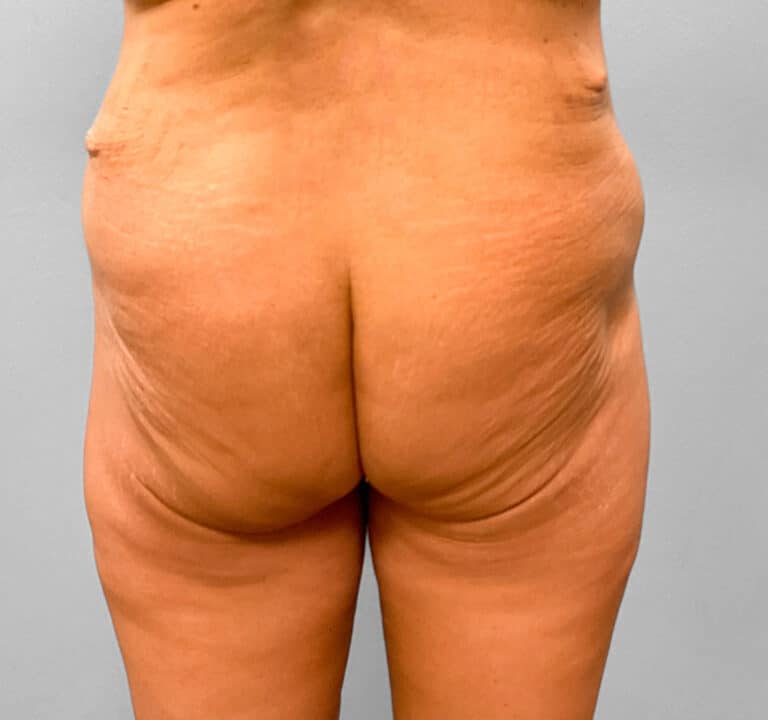 Before Image: Body Lift – Dr. Howell - back