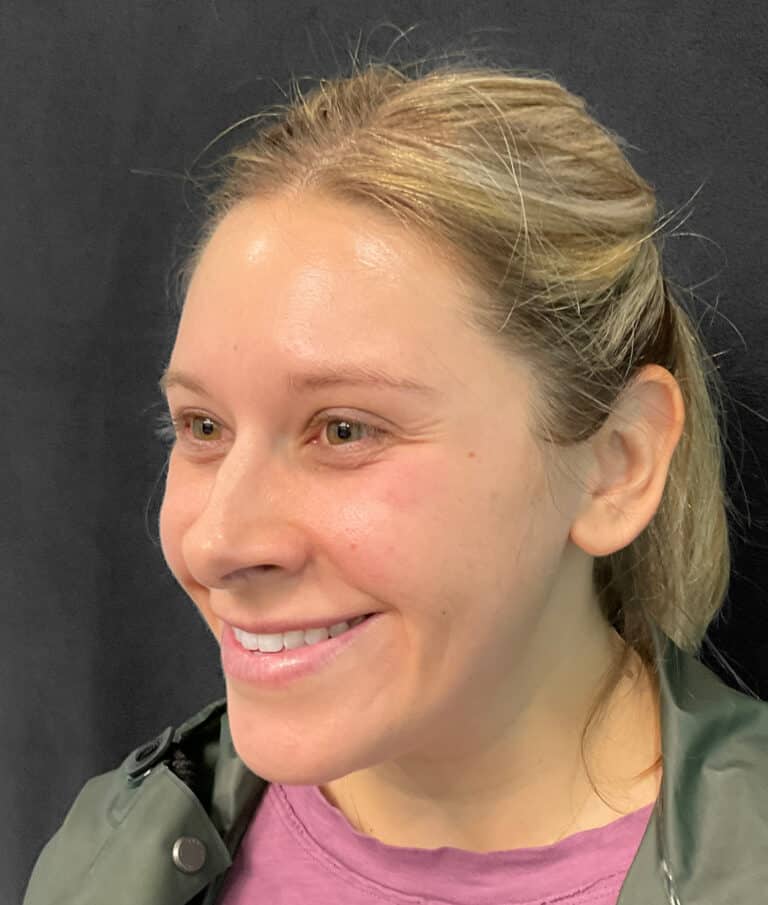 Before Image: Botox- Joy -