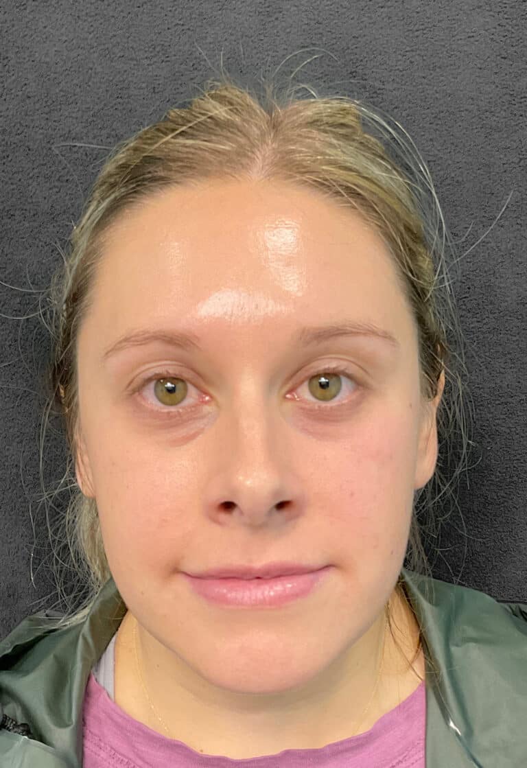 Before Image: Botox- Joy - front
