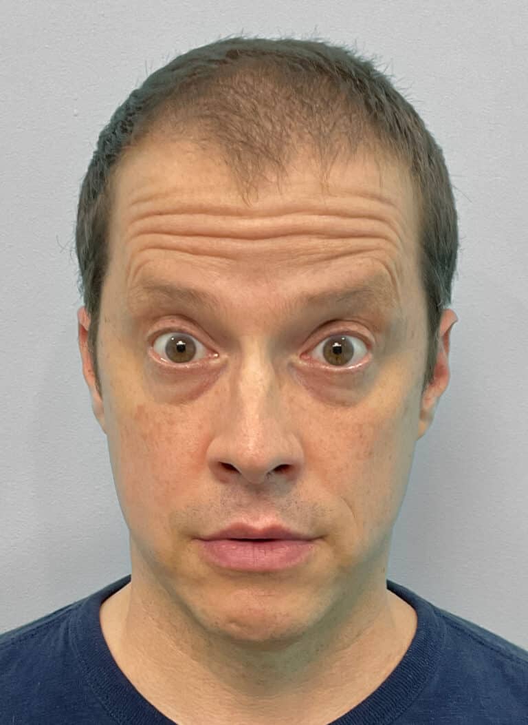 Before Image: Botox- Joy -